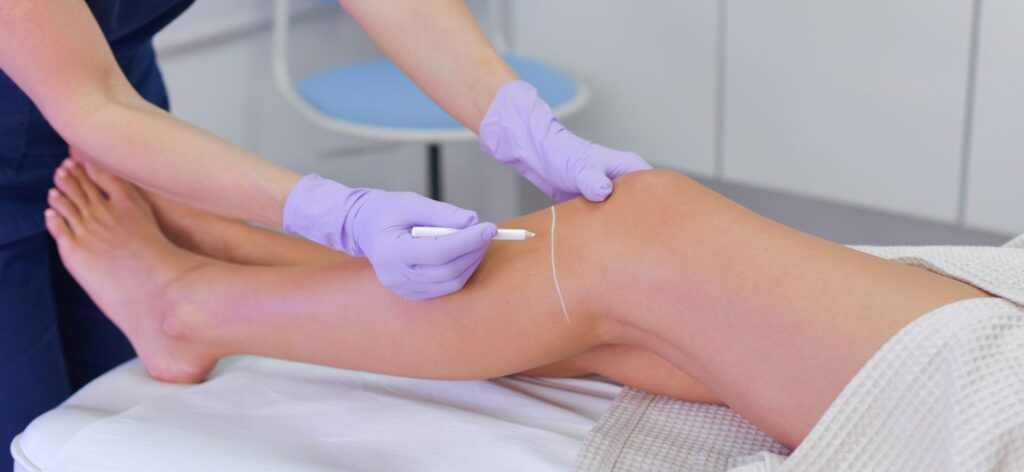 depilacja laserowa zabieg