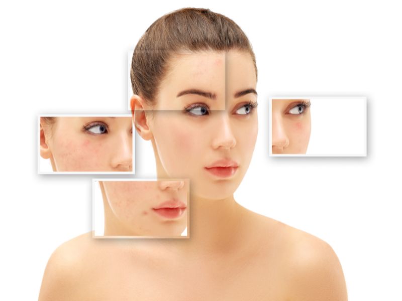 blizny potrądzikowe