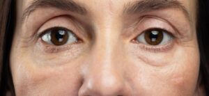 worki pod oczami jak usunąć