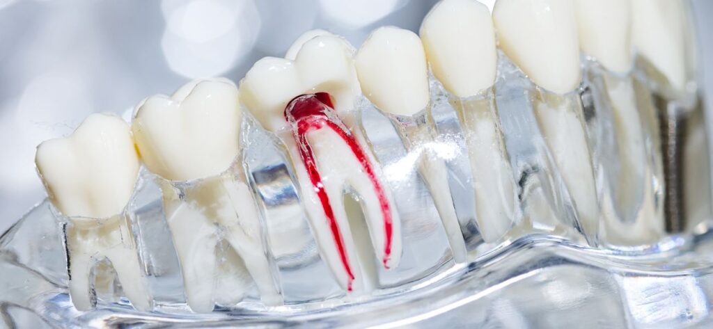 model zębów - pokazany obraz nerwów