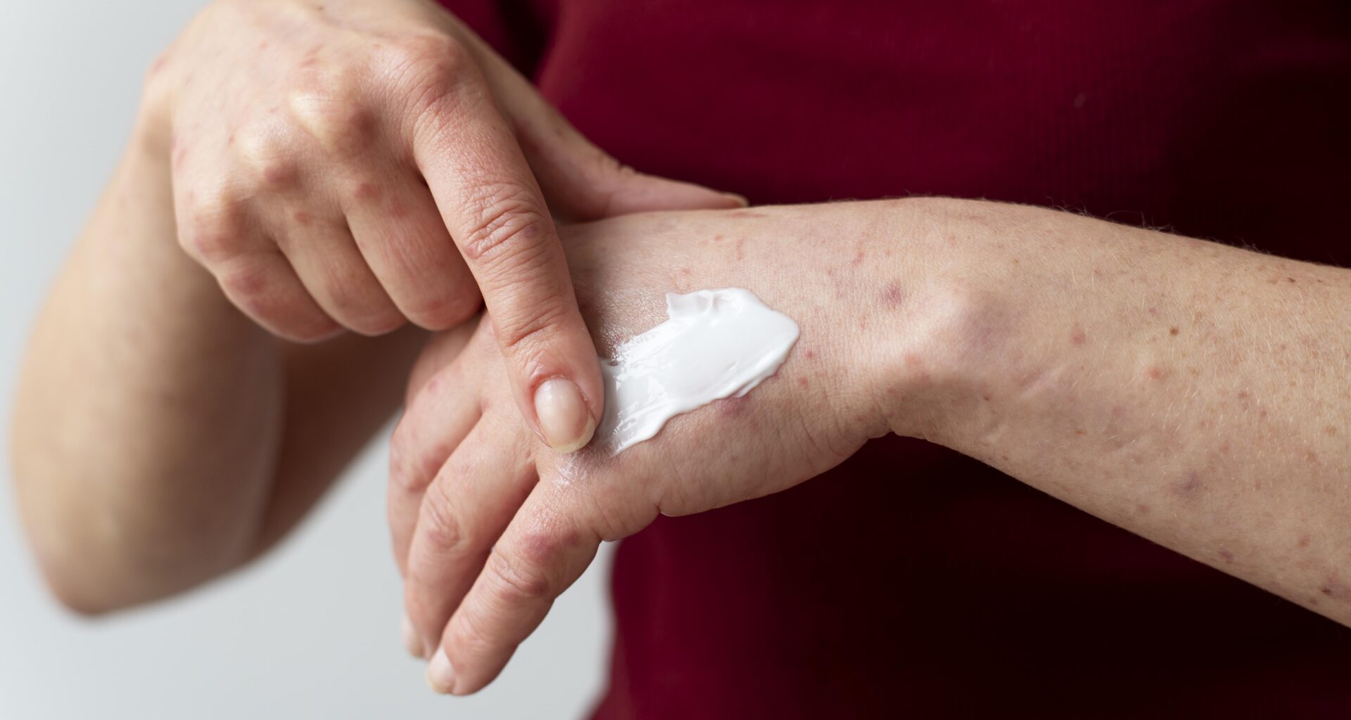 egzema problem jaki krem na egzeme